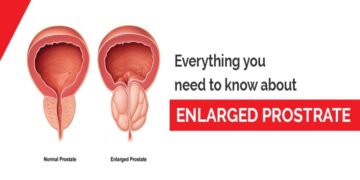 Prostate Enlargement